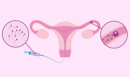 inseminaciones-hospital-sant pau-infertilymadre