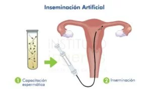 Las inseminaciones artificiales_por clínica privada