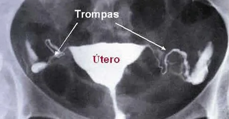 Las pruebas médicas: analíticas, histerosalpingografía y seminograma