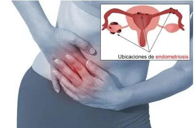 Tengo endometriosis ¿Y ahora qué?